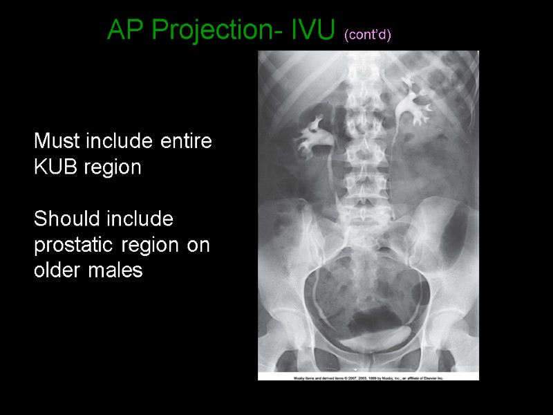 AP Projection- IVU (cont’d) Must include entire KUB region  Should include prostatic region